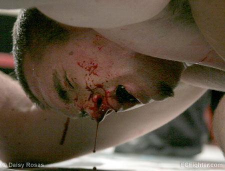 Tom Hubert dripping blood after being pounded on by Corn Zwicker.