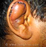 Hermes Franca's ear after surgery
